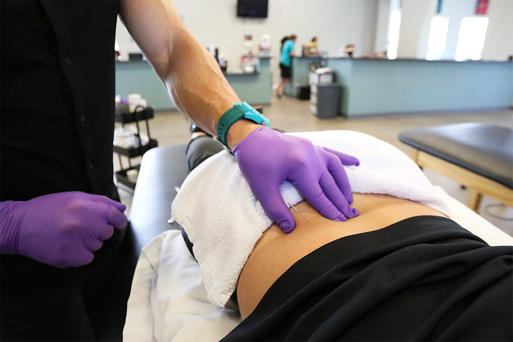 Physical therapist performing dry needling technique.