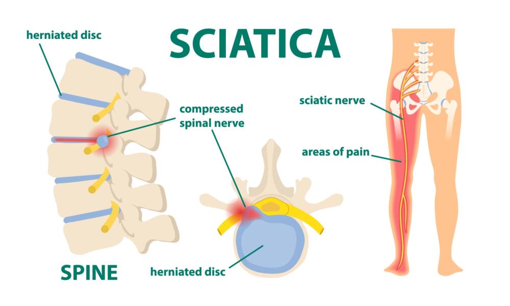 Sciatica infographic.