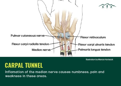 Diagram of the tendons in the hand affected by carpal tunnel syndrome