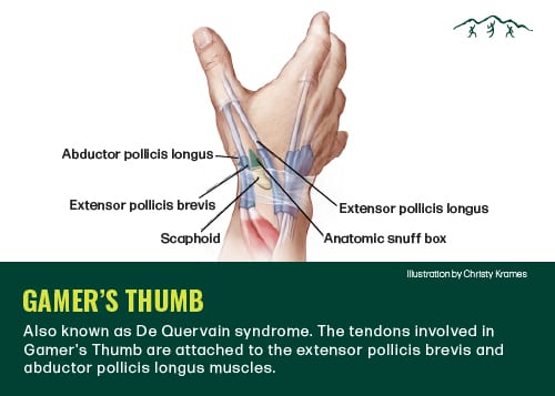 Diagram of the tendons in the hand affected by the video game injury gamer's thumb