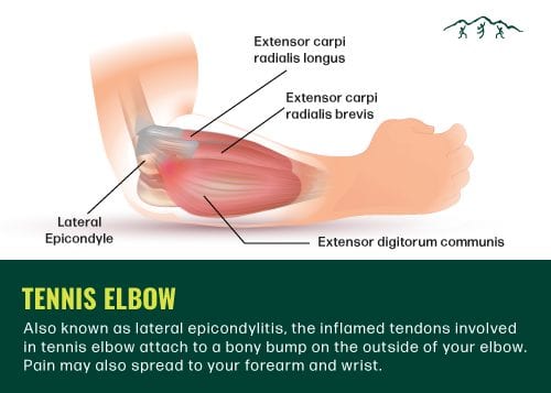 Diagram of the tendons in the arm affected by tennis elbow