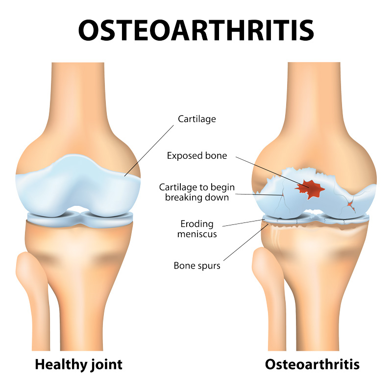 Osteoarthritis Diagram