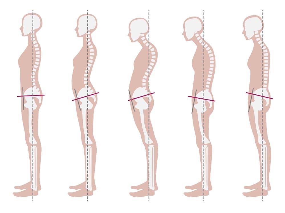 Skeletal sample of good and bad posture.