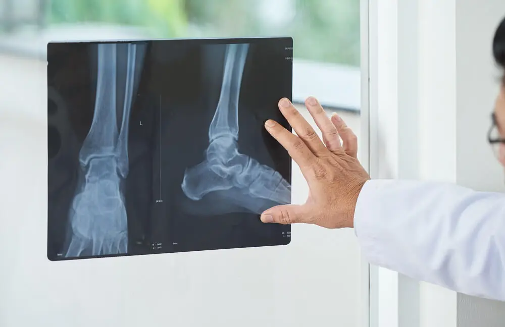 Physician looking at an xray of an ankle.
