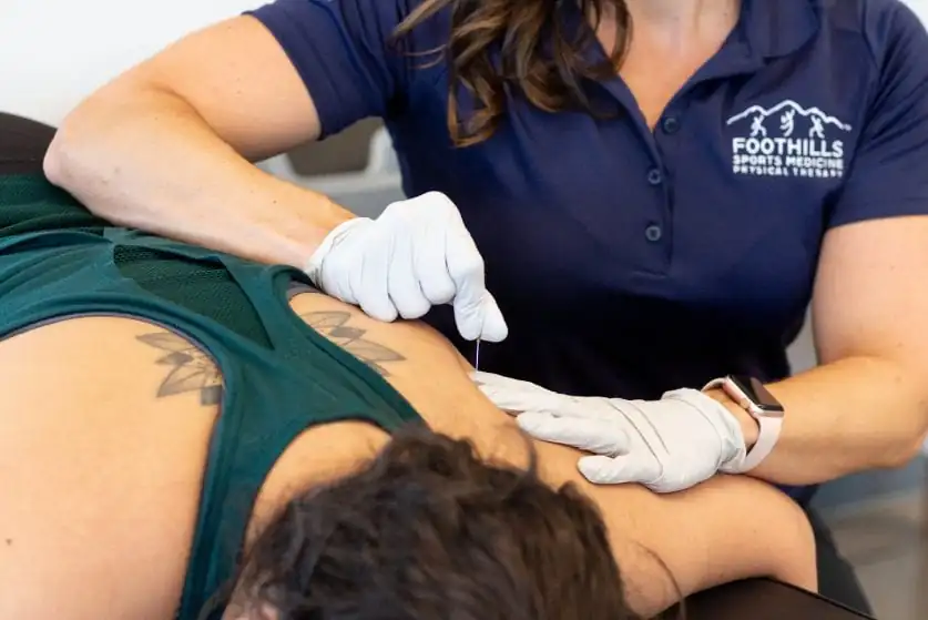 Foothills Sports Medicine Physical Therapy offers dry needling for our patients.