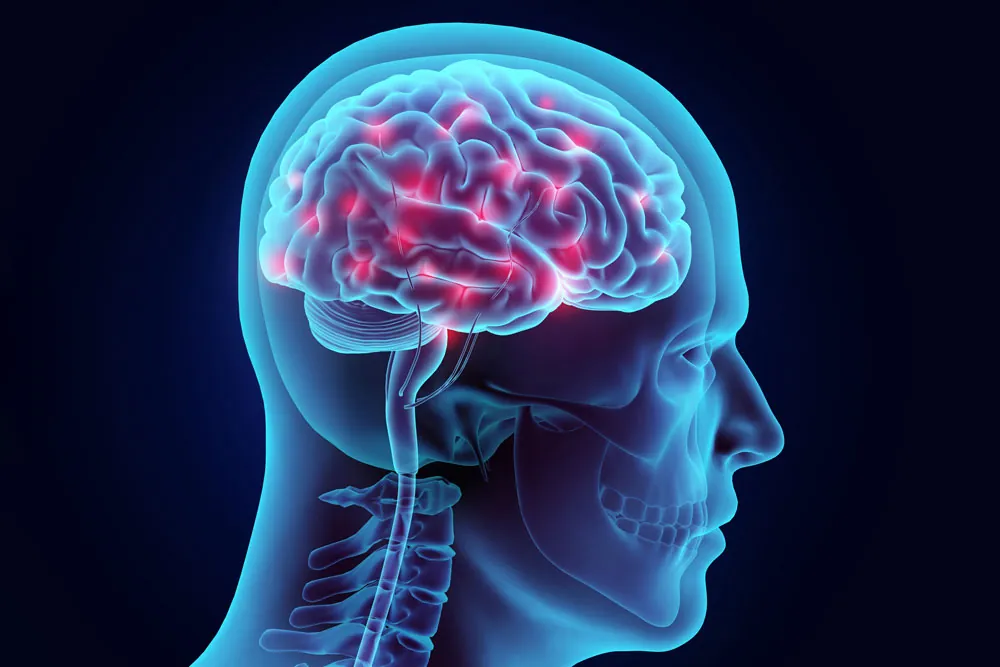 X-ray of brain injury.