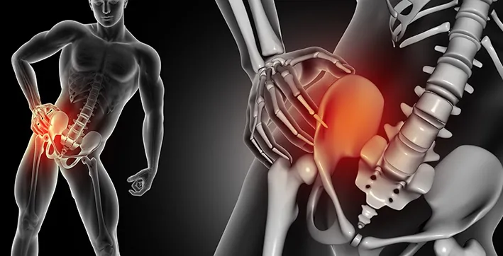 Hip pain illustration.