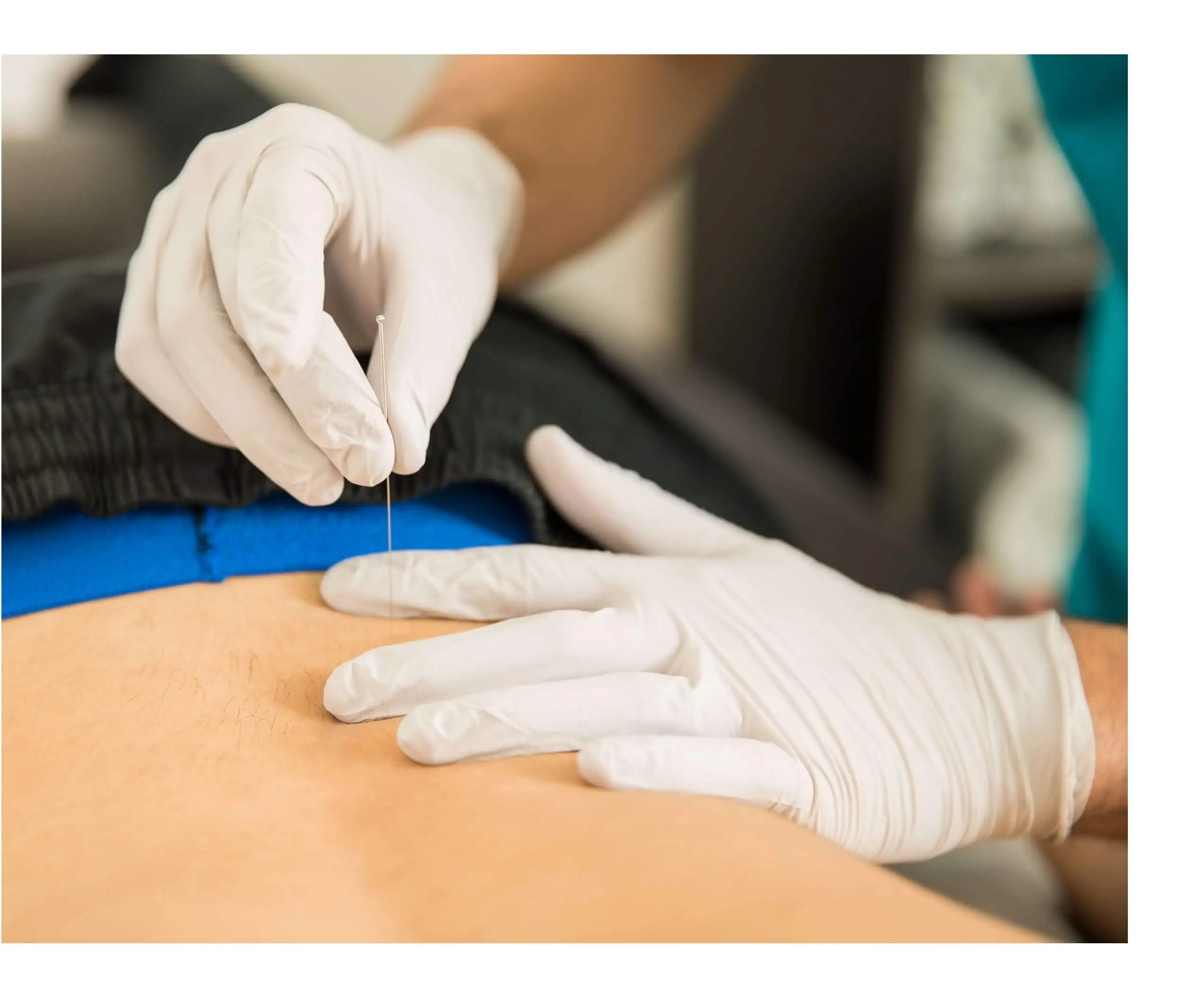 patient receiving dry needling treatment